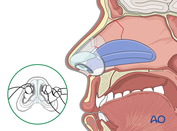 Stabilization of a nasal bone fracture with a splint.