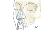 Unstable nasal bone fracture with lateral displacement.