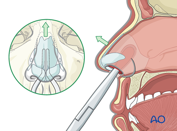 Exposing and reducing cartilaginous segments during open reduction of a nasal bone fracture.