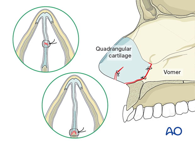 A small suture placed from the anterior nasal spine to the anterior portion of the septum to maintain reduction of a nasal bone fracture.