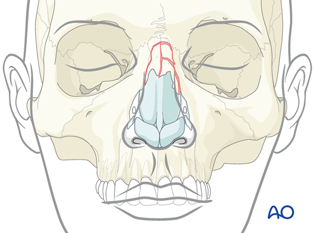 Comminuted nasal bone fracture.