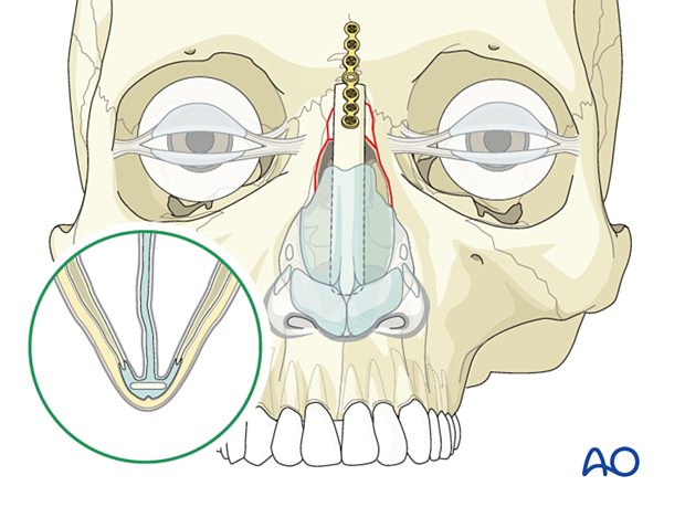 Fixation of a nasoorbitoethmoid type III fracture with nasal bone involvement using a bone graft and plate plates.