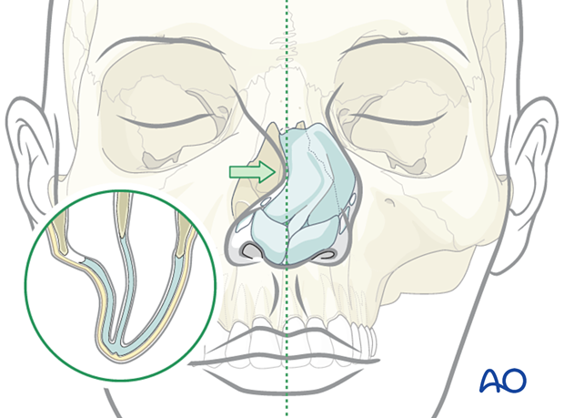 Disarticulation of upper lateral nasal cartilage.