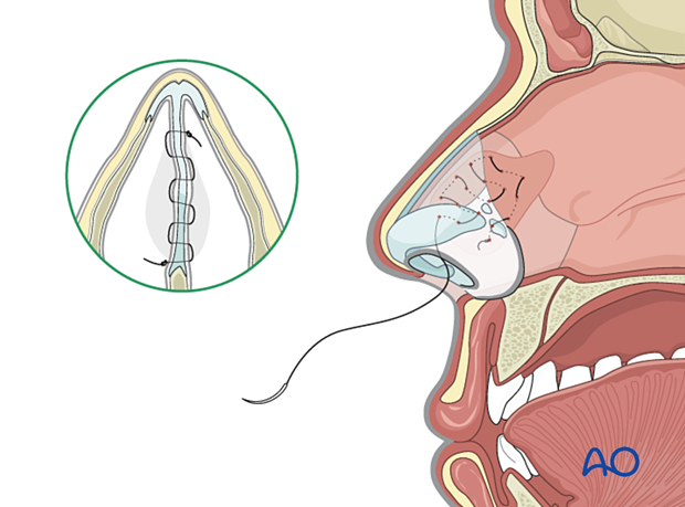 Quilting stitch back and forth across the septum used in treatment of a nasal septum hematoma.