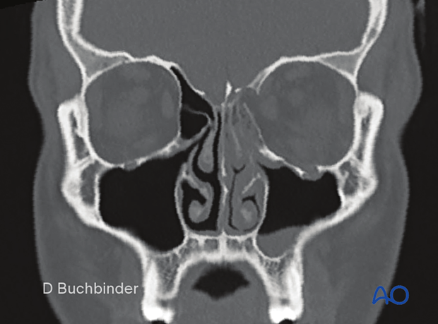 Coronal slice (bone window) of an isolated minimally displaced left orbital floor fracture with minimal volume change
