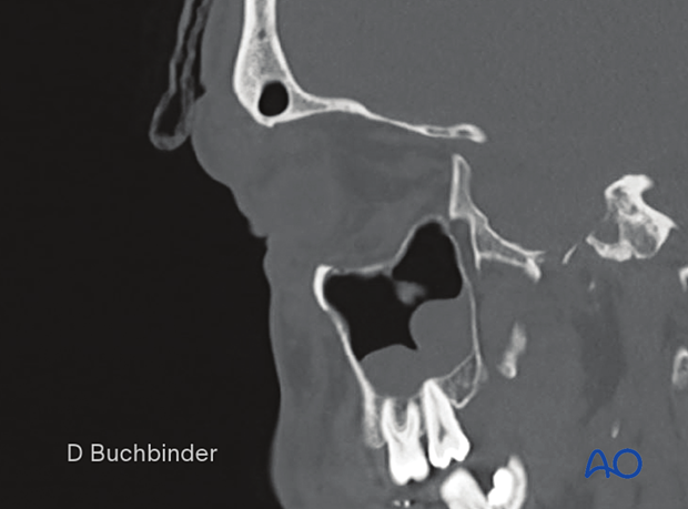 Orbital floor fracture - Sagittal slice