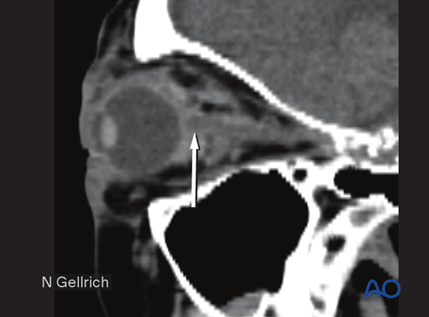 Sagittal view of a CT scan demonstrating a small retrobulbar hematoma 