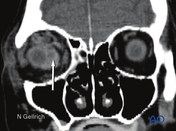 Coronal view of a retrobulbar hematoma.