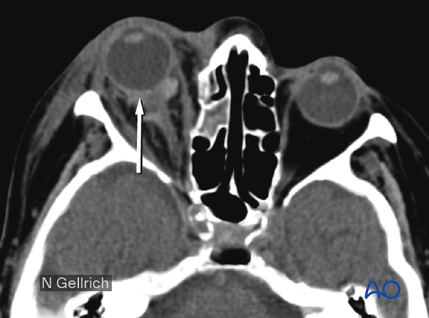 Axial view of a retrobulbar hematoma.