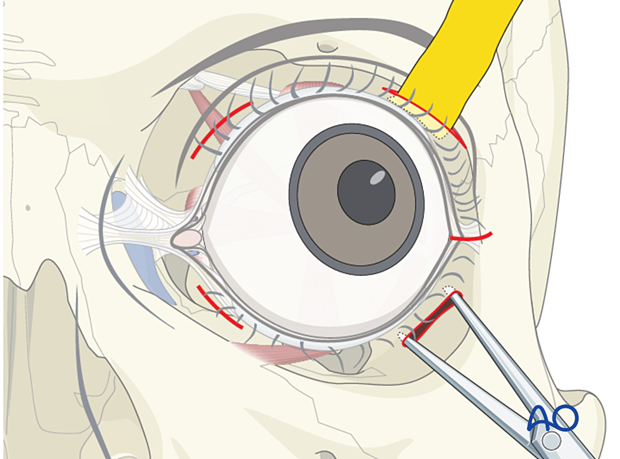 Transcutaneous transseptal incisions reconstruction help evacuate the hematoma and relieve excess periorbital pressure from a retrobulbar hematoma. 