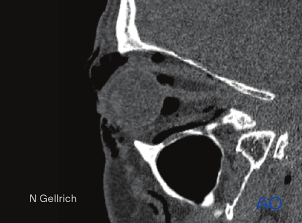 CT scan showing signs of intraorbital emphysema.