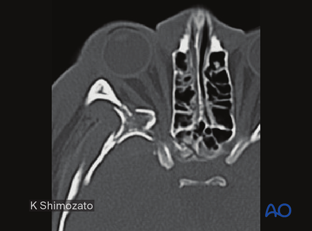 Axial CT scan in the plane of the optic nerve showing multiple fractures of the lateral orbital wall and greater wing of the sphenoid of the right side reconstruction.