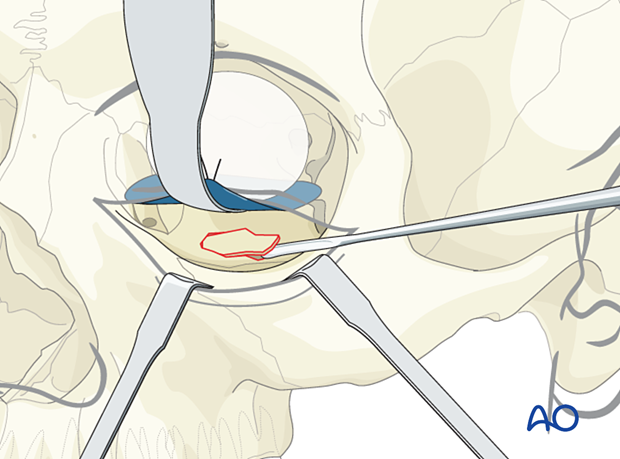 Reduction of an orbital floor fracture.