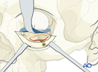 Orbital floor fracture