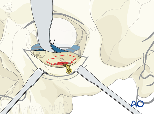 Fixation of an orbital floor fracture using a small bone plate.