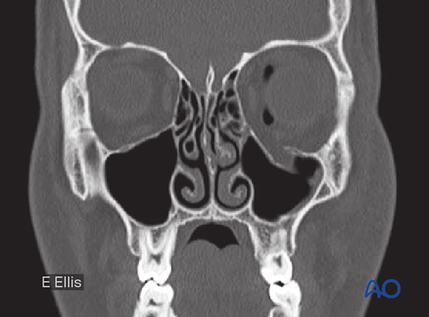 Preoperative coronal CT scan showing an unstable orbital floor fracture.