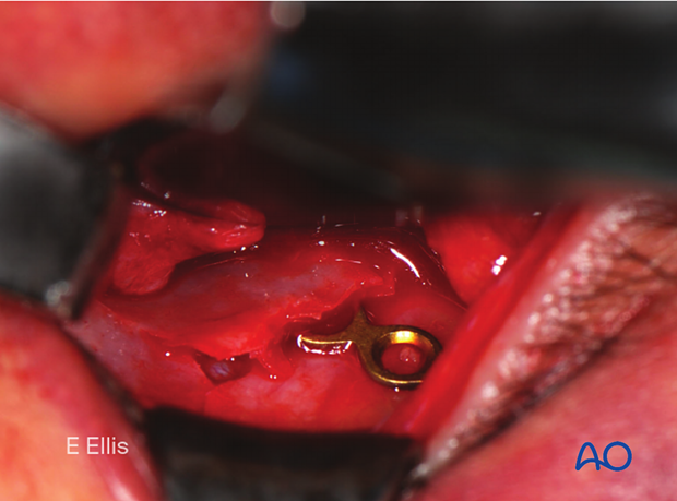 Interoperative photograph showing the fixation of an orbital floor fracture using a small bone plate.