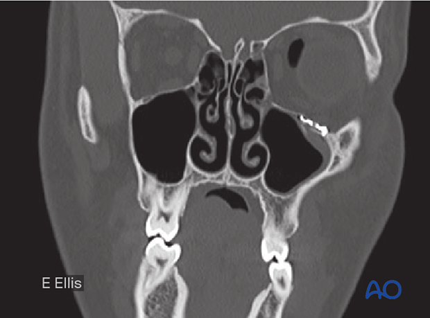 Postoperative coronal CT scan showing the fixation of an orbital floor fracture using a small bone plate.