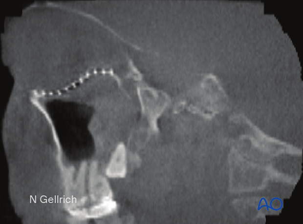 CT scan slice showing the slope of the orbital floor and fragments of the orbital ledge.