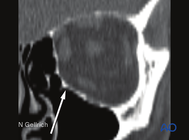 Coronal CT scan showing the transition zone just prior to where this posterior bone bulges inward orbital reconstruction.