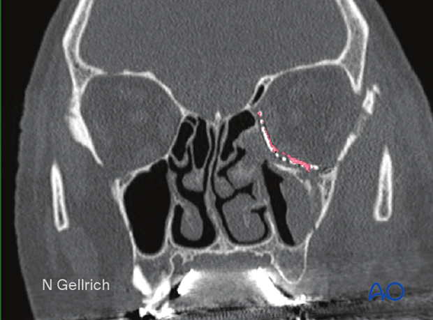 Coronal slice of a postoperative CT scan showing repair of the left medial orbital wall and orbital floor orbital reconstruction.