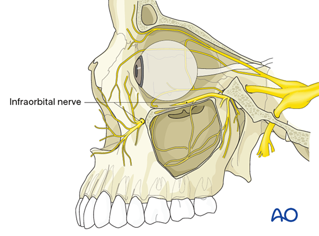 The course of the infraorbital nerve in the orbital floor.