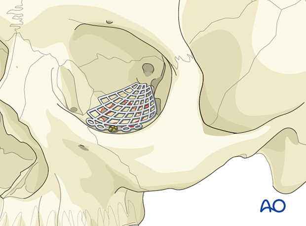 Orbital mesh placement in orbital floor reconstruction.