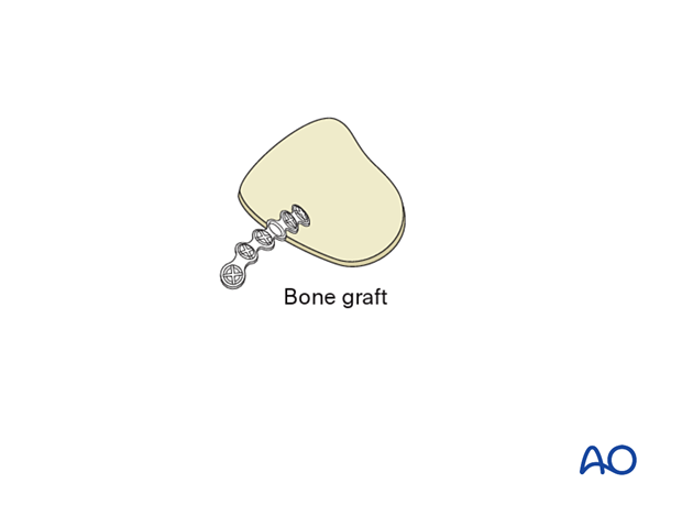 Calvarial bone graft stabilized by a titanium fixation plate.