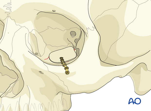 Calvarial bone graft stabilized by a titanium fixation plate.to the orbital rim in orbital floor reconstruction.