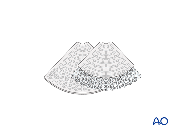 Composite of porous polyethylene and titanium mesh for orbital reconstruction.