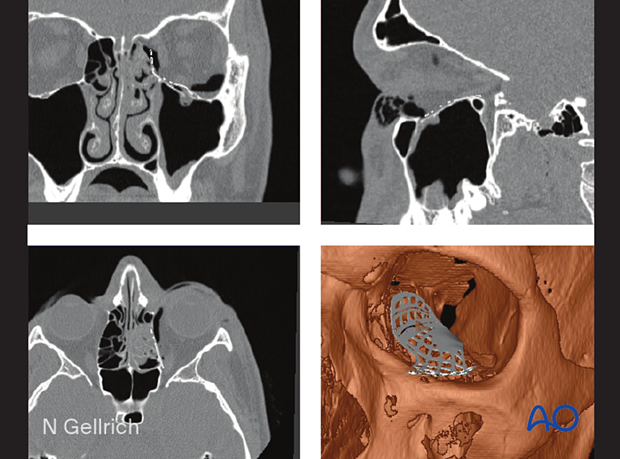 Multiplanar and 3D view showing a preformed mesh plate placed before surgery into patient CT dataset.