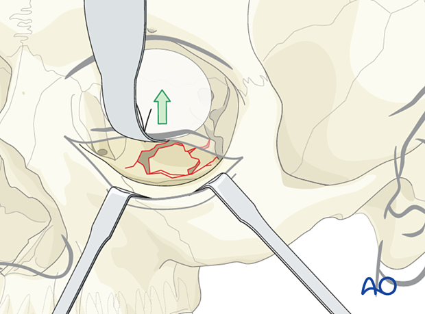 Retraction of the intraorbital soft tissue during orbital floor reconstruction.
