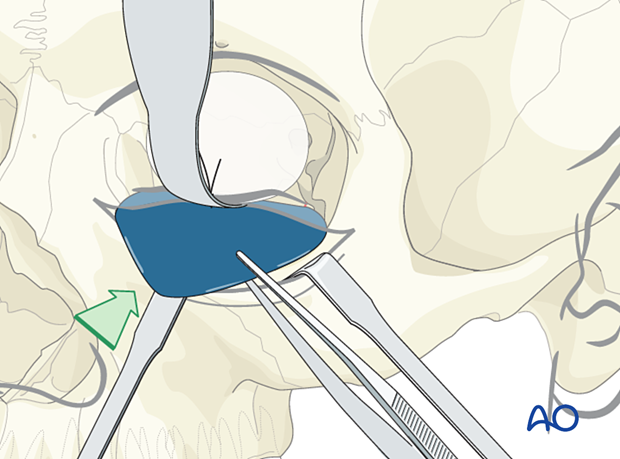 Insertion of a foil below the retractor for orbital floor reconstruction.