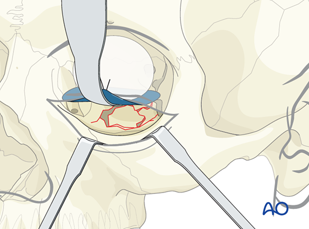 The retractor is removed, placed under the foil, and the orbital soft tissues are adequately retracted during orbital floor reconstruction.