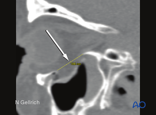 Preoperative CT showing the extent of an orbital floor fracture in sagittal view.