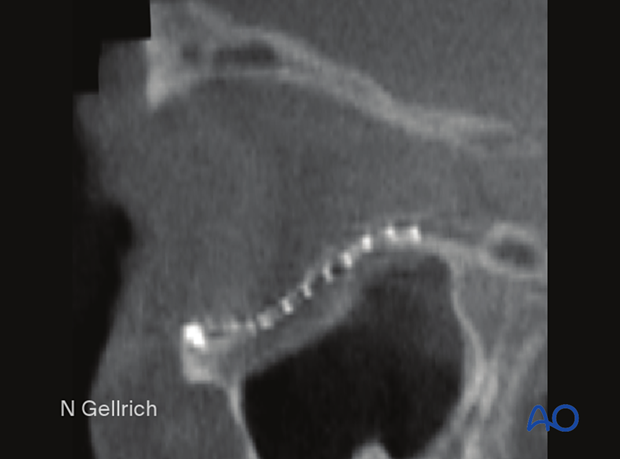 Postoperative CT showing the S-shaped recontouring of the orbital floor.