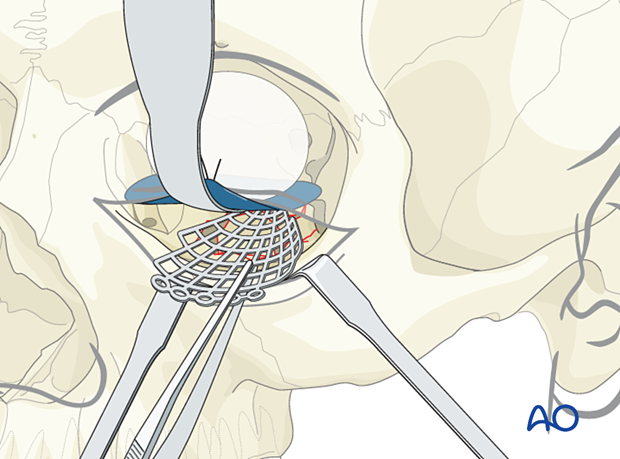 Insertion of titanium mesh plate under the retractor and foil during orbital floor reconstruction.