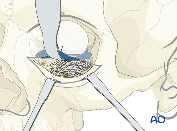 Fixation of the titanium mesh with one screw in anterior floor of the orbit just posterior to the orbital rim in orbital floor reconstruction.