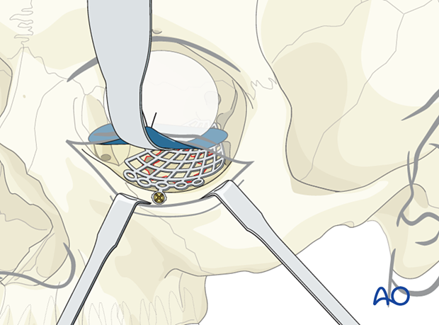 Titanium mesh extending over the orbital rim and fixed with one screw in orbital floor reconstruction.