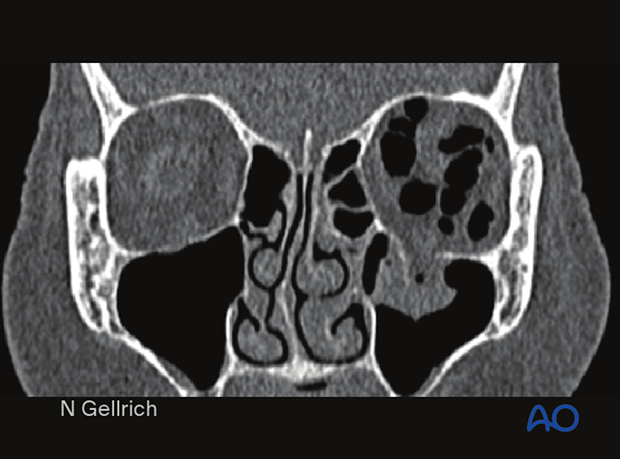 Coronal CT of an isolated left orbital floor fracture orbital reconstruction.