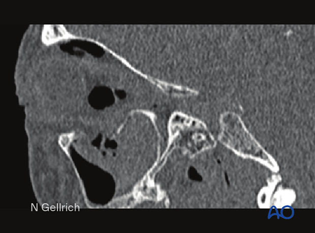 Sagittal CT slices showing a large defect in the orbital floor with herniation of the periorbita into the maxillary sinus.