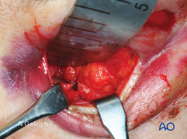Clinical photograph showing the transconjunctival incision and exposure of the fracture during orbital floor reconstruction.