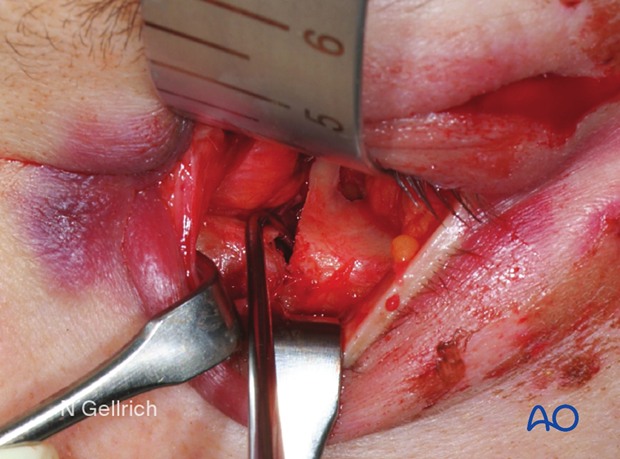 Clinical photograph showing the repositioning of the fracture fragment during orbital floor reconstruction.
