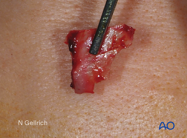 Clinical photograph showing the removal of the displaced orbital floor fragment during orbital floor reconstruction.