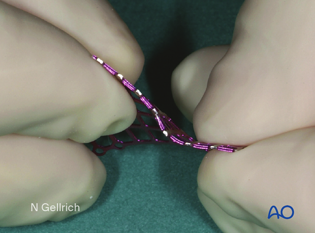 Photograph showing the bending the mesh form the bulges during orbital reconstruction.