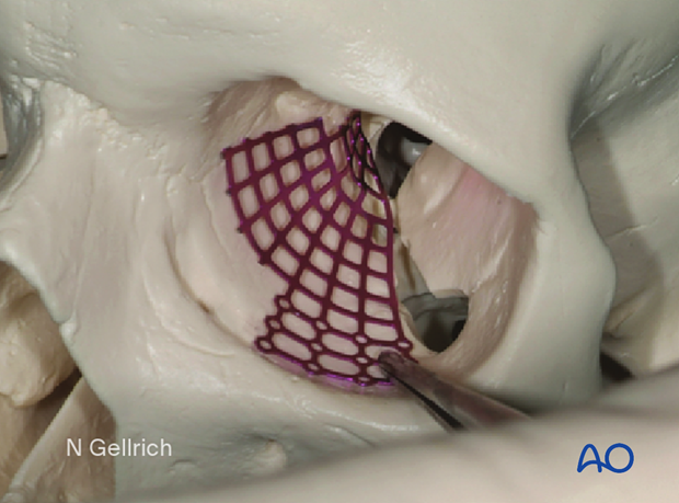 Photograph showing the contoured mesh placed in sterile artificial skull to check contouring during orbital floor reconstruction.