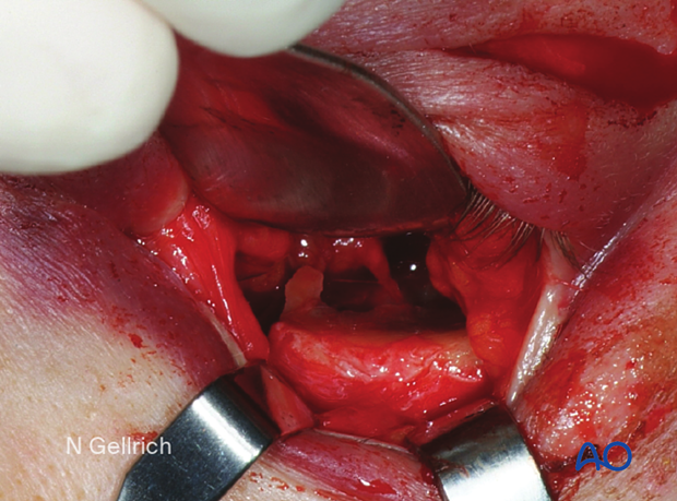 Clinical photograph showing the exposure of the orbital floor before mesh insertion.