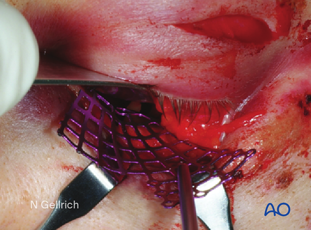 Clinical photograph showing the insertion of the trimmed mesh during orbital floor reconstruction.