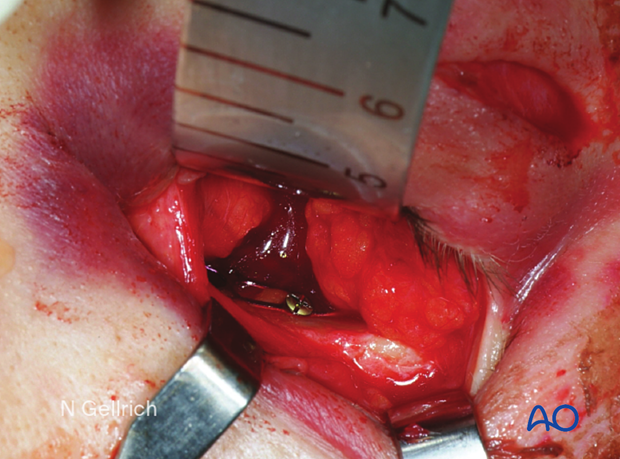 Clinical photograph showing single screw fixation posterior to the orbital rim during orbital floor reconstruction.