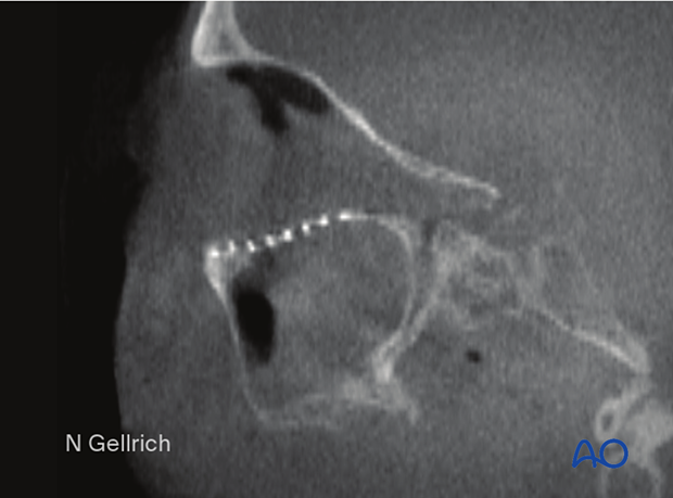 CT scan slice showing the slope of the orbital floor and fragments of the orbital ledge during orbital floor reconstruction.